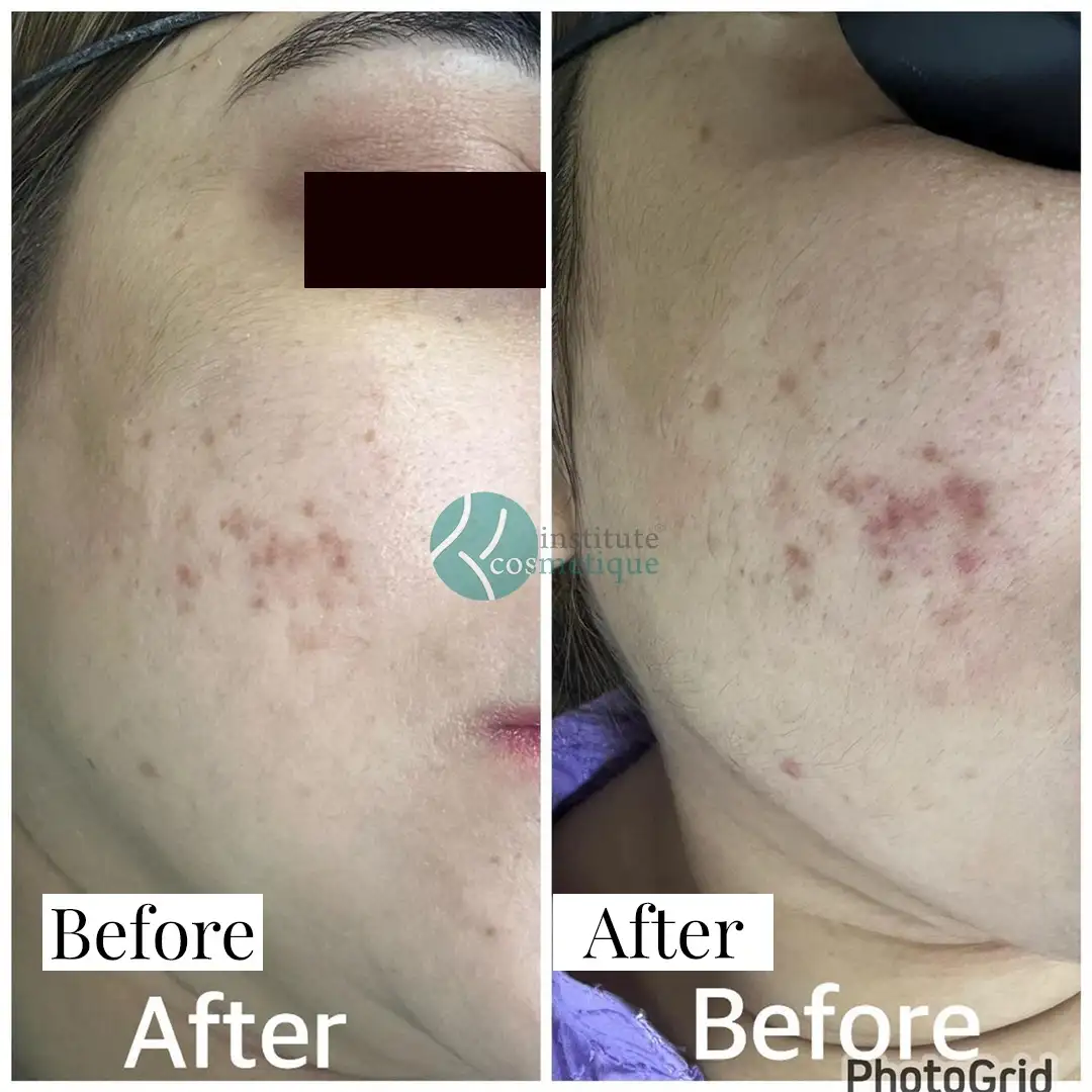 Skin tightening and wrinkle reduction before and after HIFU therapy at Institute Cosmetique